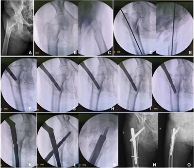 The use of intramedullary reduction techniques in the treatment of irreducible intertrochanteric femoral fractures with negative medial cortical support